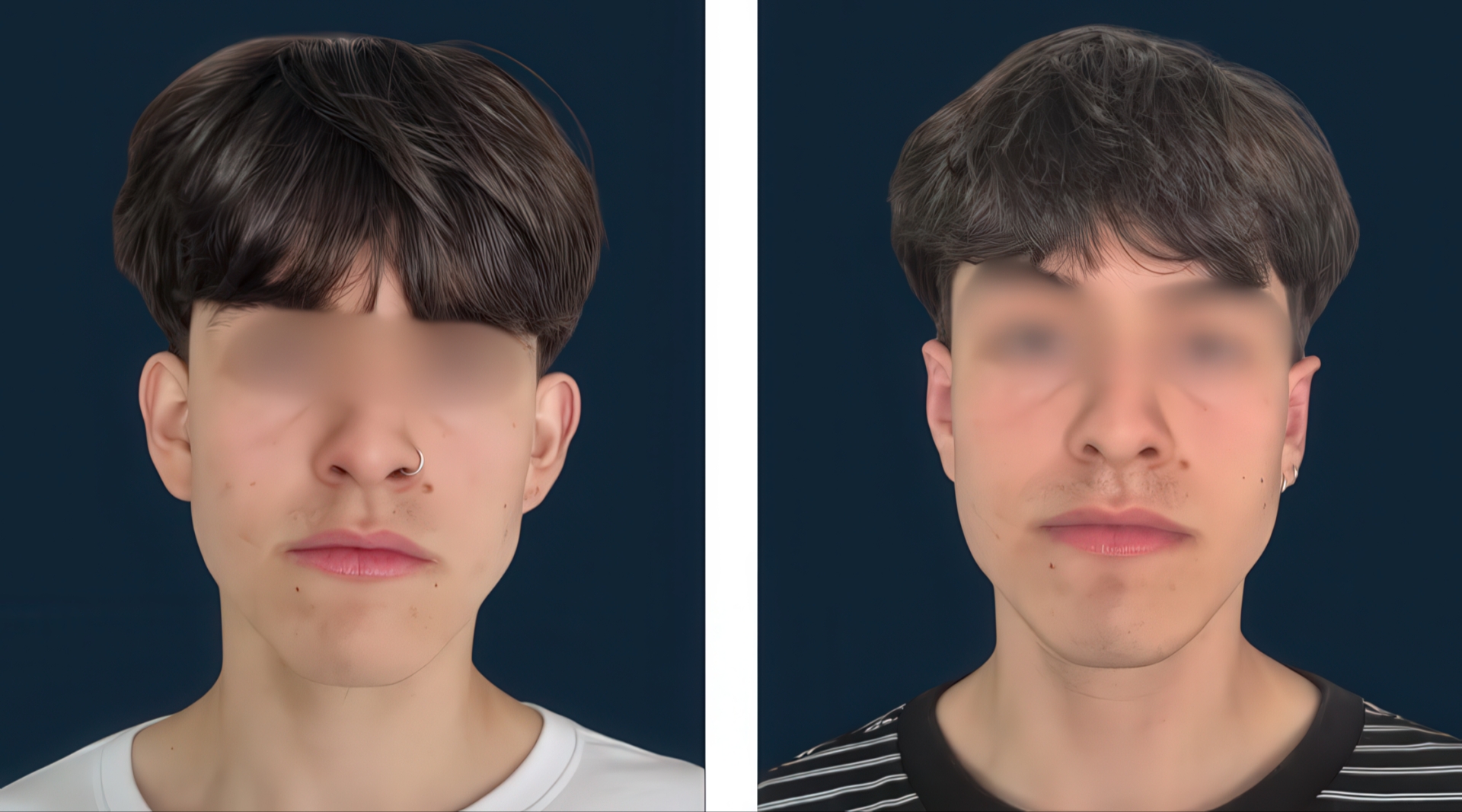 Antes y después de otoplastia